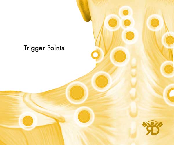 dry needling trigger points